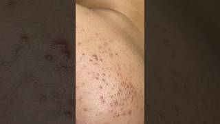 A Short Preview of This Blackhead Cluster 👀 #shorts #shortvideo #blackheads