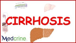 LIVER CIRRHOSIS (causes,pathophysiology,features,diagnosis,treatment)