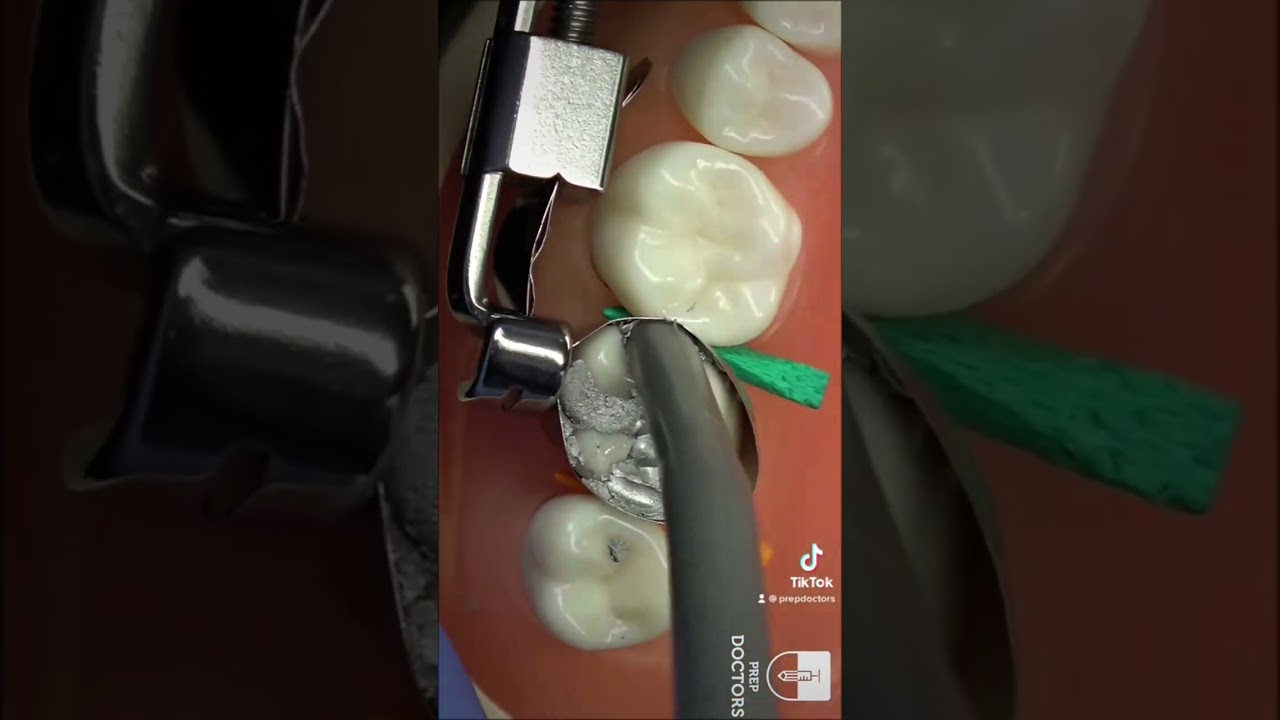 #dentalexam #dentist #canada #clinicalskills #amalgam #carving #ndecc #acs #continuingeducation