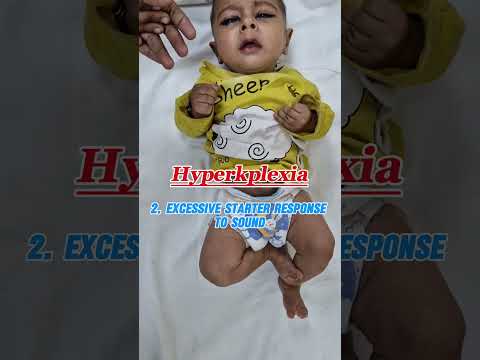 Hyperkplexia in infants | Excessive startle response