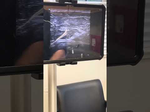 Trochanteric bursa injection w/ Gluteal tendon landmarks.