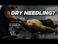 Jonathan Gets Dry Needling| Visit to Kinetikchain| JI Fitness