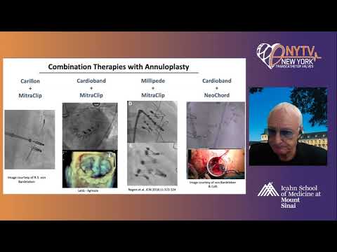 Next Generation Mitral Devices for Repair/Replacement - Dr. Eberhard Grube