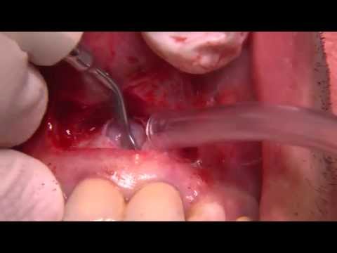 Caviglia urto Dolori articolari e pigne