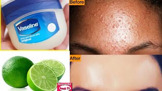 How To Remove Pimples Overnight / Acne Treatment Get rid of pimples overnight Vaseline and Lemon