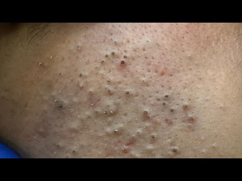 Advanced Blackhead Removal Techniques — Deep Cleansing for Clear Skin