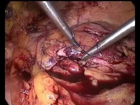 GSD e mal di schiena Se a bruciare una persona con osteocondrosi cervicale