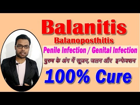 Balanitis | How to Cure Balanitis | पुरुष के अंग में सूजन जलन और इन्फेक्शन का इलाज Video