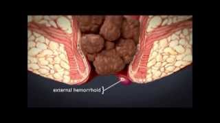 HEMORRHOiDS | What are hemorrhoids ? What is the treatment for hemorrhoids ?