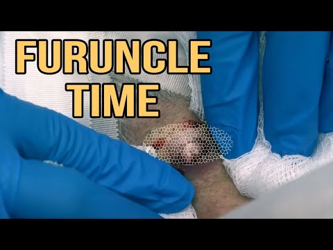 Owen's Neck Furuncle - Ouch -Top Videos #37