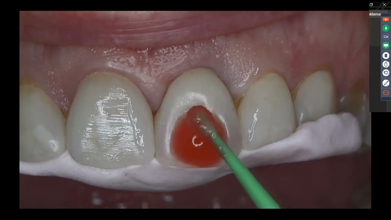 BEGO Implant Systems – Digital Approach in Periimplantary Pink & White Esthetics
