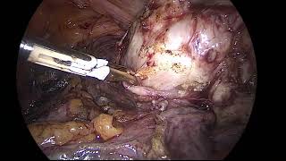 Left parametrial myomectomy