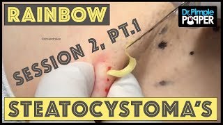 Rainbow Steatocystomas - Session 2, Pt. 1