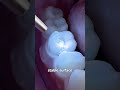 How Dentists Repair A Split Tooth