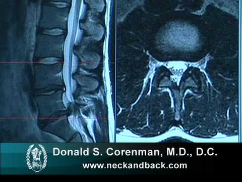How to Read a MRI of a Lumbar Herniated Disc | Lower Back Pain | Colorado Spine Surgeon