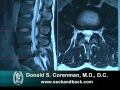 How To Read A MRI Of A Lumbar Herniated Disc Lower Back Pain Colorado Spine Surgeon