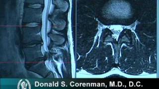 How to Read a MRI of a Lumbar Herniated Disc | Lower Back Pain | Colorado Spine Surgeon