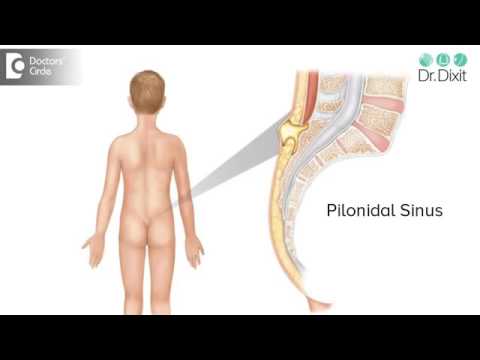 DIAGNOSIS AND MANAGEMENT OF BOIL ON BUTTOCK AREA  | DR RASYA DIXIT | SKIN CARE TIPS