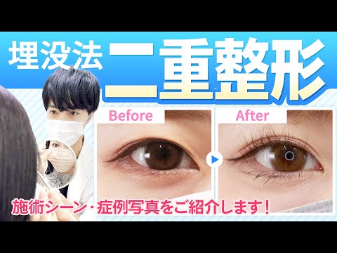 【埋没法･二重整形】自然な二重ができるまで！施術に密着！【ドクターもりもり】