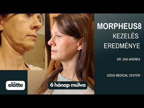 Morpheus8 eredmény!