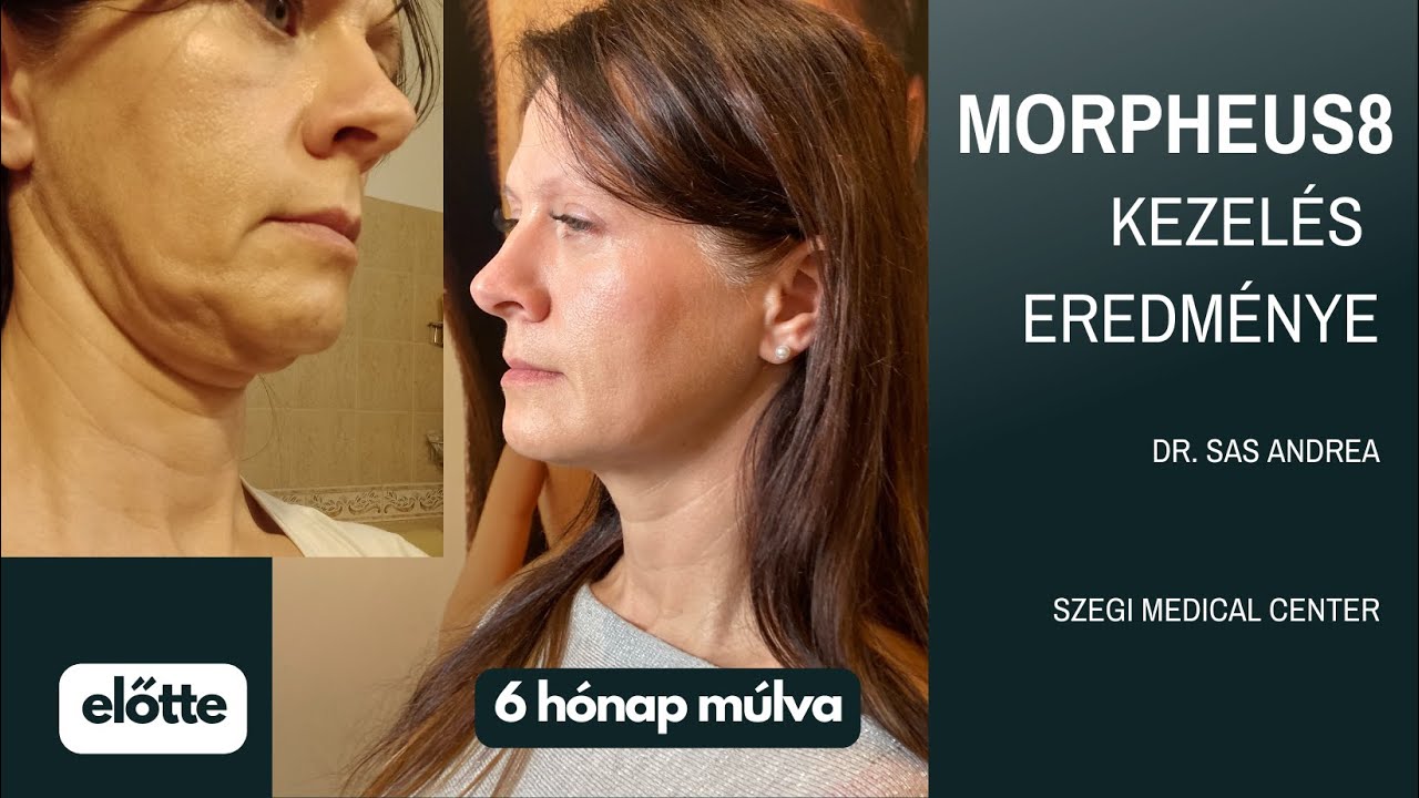 Morpheus8 kezelés eredménye!