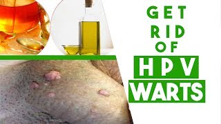 How to Get Rid of HPV Genital Warts at Home Fast - 3 Tips You MUST Know