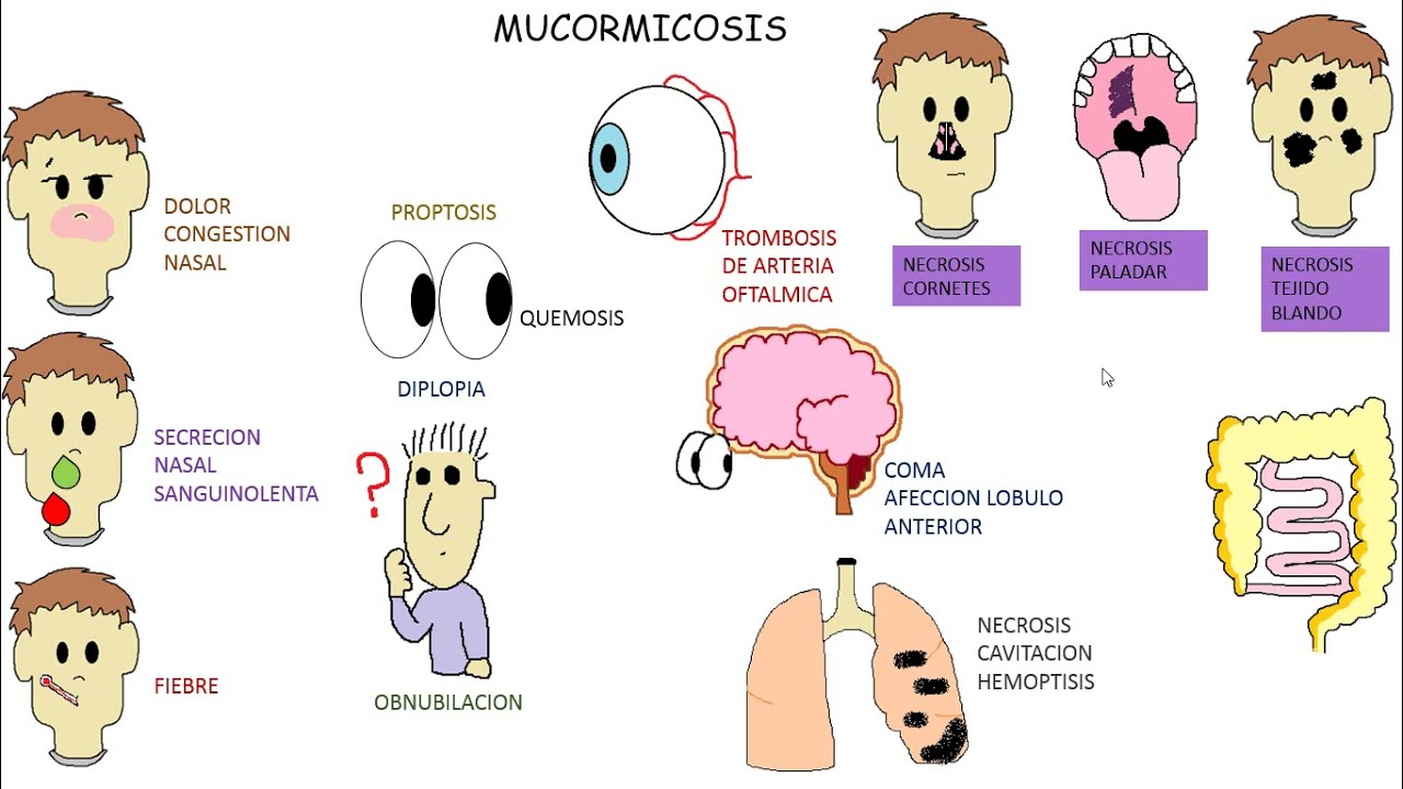 HONGO NEGRO mucormicosis