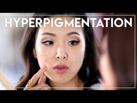 HOW TO FIX ACNE HYPERPIGMENTATION || Jen Chae Video
