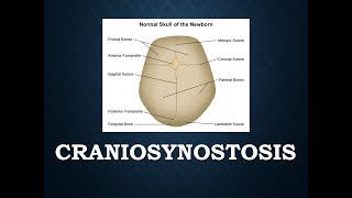 Craniosynostosis - an overview
