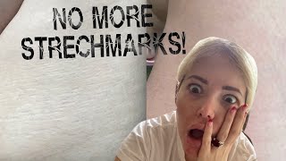 I CURED MY STRECHMARKS!! DIY MICRONEEDLING!