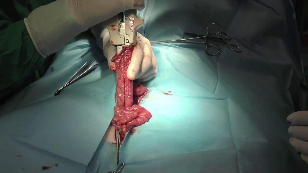 Cómo hacer paso a paso una anastomosis intestinal con una sutura mecánica