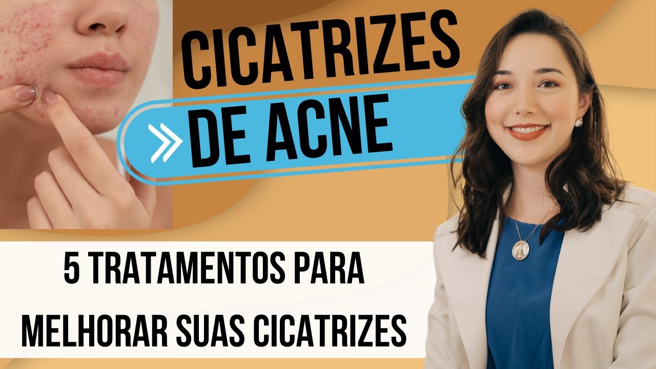 CICATRIZ DE ACNE:  5 tratamentos para melhorar suas cicatrizes de acne