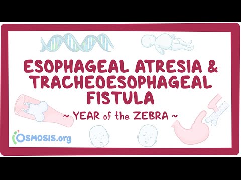 Achalasia Year of the Zebra