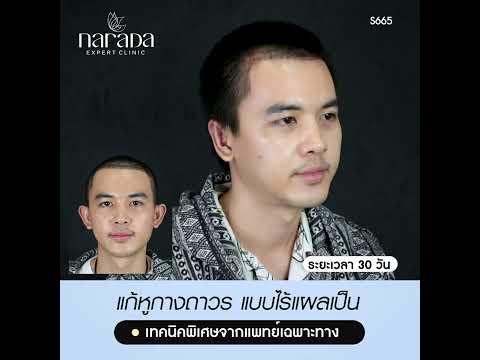 แก้ไขหูกางถาวร แบบไร้แผลเป็น  โดยแพทย์เฉพาะทาง หู คอ จมูก ที่ นารดาคลินิก แก้ไขหูกางถาวร แบบไร้แผลเป็น  โดยแพทย์เฉพาะทาง หู คอ จมูก ที่ นารดาคลินิก