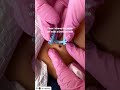 Mole Removal
