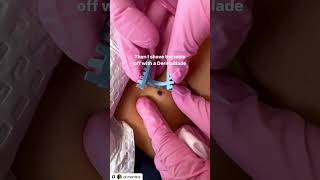 Download lagu Mole Removal mp3 Download lagu Mole Removal mp3