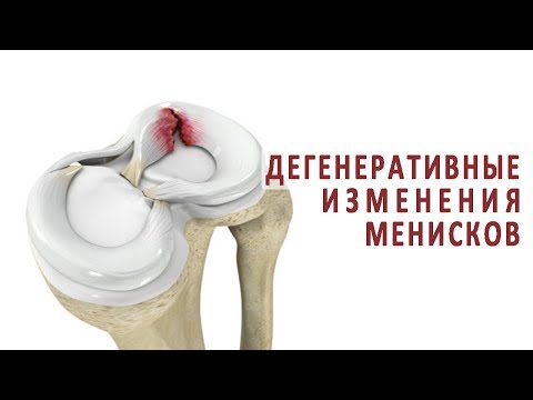 Что нужно знать о дегенеративных изменениях менисков