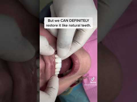 Dental Crowns and Dental Veneers are NOT the same! This case - zirconia crowns #apostolified #smile