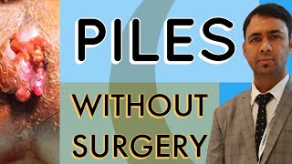 PILES TREATMENT - WITHOUT SURGERY ?