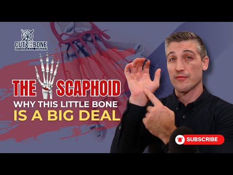 Scaphoid Fractures Explained: Why This Little Wrist Bone Matters!