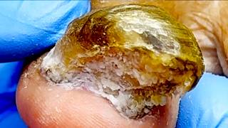 Wow, This Is Amazing, The Onychomycosis Is Super Thick!【Xue Yidao】