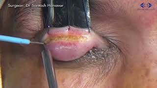 Entropion Correction Marginal Rotation