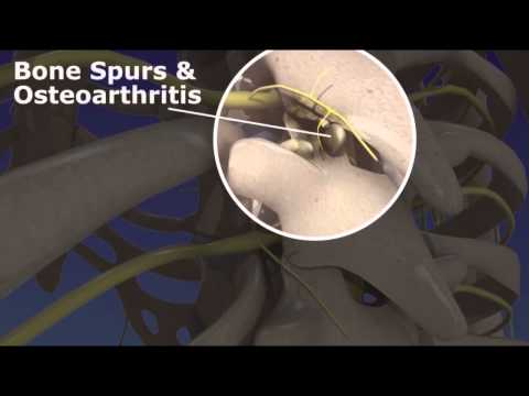 Thoracic Facet Radiofrequency Neurotomy - Upper Back