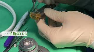 內膜細胞眼角膜移植手術│簡鴻仁醫師