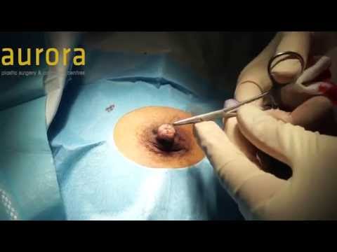 Bilateral Inverted Nipple Correction Surgery