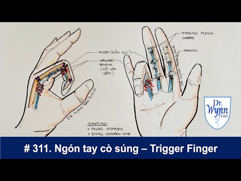 Ngón tay bị kẹt (ngón tay cò súng) - Trigger Finger