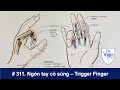 #311. Ngón tay bị kẹt (ngón tay cò súng) - Trigger Finger