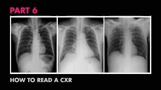 CXR Bones & Soft Tissue - How to Read a Chest X-Ray (Part 6) - MEDZCOOL