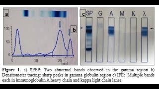 Protein Immunofixation for Plasma Cell Dyscrasia
