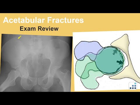 Acetabular Fractures Exam Review - Ben Taylor, MD